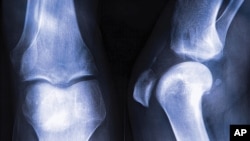 This x-ray shows osteoporosis in a leg joint. 