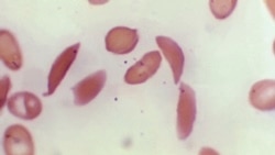 Quiz - Possible New Cure for Sickle Cell Disease
