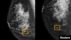 A yellow box indicates where an artificial intelligence (AI) system found cancer hiding inside breast tissue, in an undated photo released by Northwestern University in Chicago, Jan. 1, 2020. 