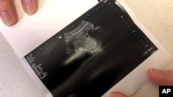 Supreme Court Abortion