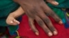Poor Nutrition Stunts Growth of One-third of Cameroon Children