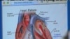 Chest Compressions Life-Saving After Cardiac Arrest