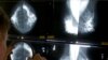 Low-dose Aspirin Might Reduce Risk of Most-common Breast Cancer 