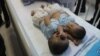 Bayi kembar siam dempet perut asal Tapanuli Utara, Sumatera Utara, sebelum menjalani operasi pemisahan di Rumah Sakit Umum Pusat H Adam Malik Medan. (Courtesy: Humas RSUP H Adam Malik)