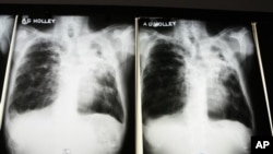 MDR-TB adalah penyakit yang kebal terhadap dua obat yang paling banyak digunakan dalam standar pengobatan TB. Bila penyakit itu menjadi kebal terhadap kedua obat tambahan itu, maka penyakit itu berubah menjadi XDR-TB (foto: dok).