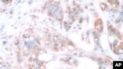 Invasive breast cancer tissue